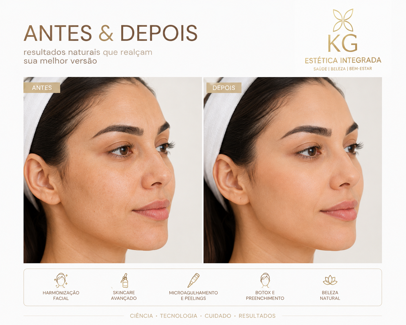 Antes e depois de harmonização facial, skincare avançado, microagulhamento, peelings, botox e preenchimento na KG Estética Integrada